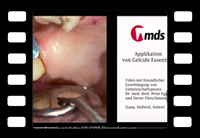 Applikation von GELCIDE ESSENTIALS in eine gereinigte 12 mm tiefe Zahnfleischtasche.